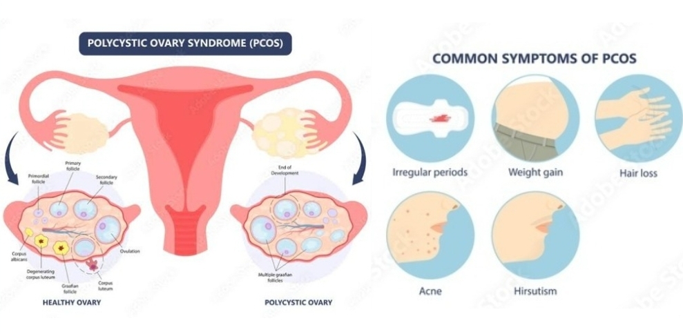 多嚢胞性卵巣症候群（PCOS）って何だろう？